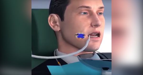Công nghệ trám răng mới hiện đại ra sao?