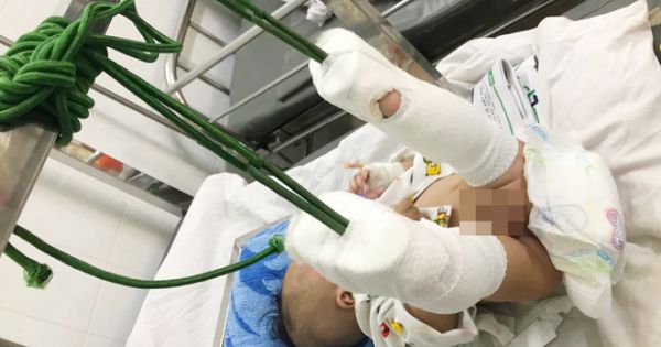 Bé trai 4 tháng tuổi nghi bị cha đánh xuất huyết não