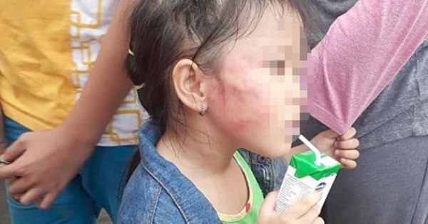 TPHCM: Bé gái 5 tuổi bị giáo viên mầm non đánh sưng mặt
