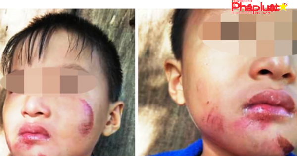 Một cháu bé 6 tuổi nghi bị chính mẹ ruột đánh dã man