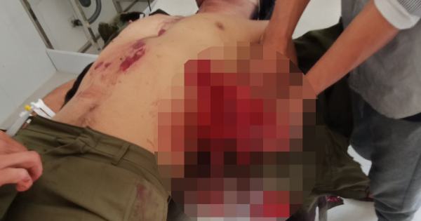 Lâm Đồng: Mìn đánh cá tự chế phát nổ, 7 người bị thương
