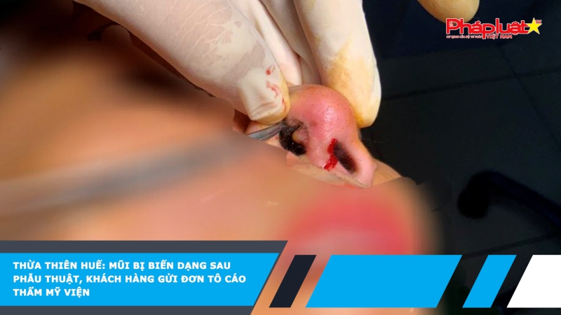 Thừa Thiên Huế: Mũi bị biến dạng sau phẫu thuật, khách hàng gửi đơn tô cáo thẩm mỹ viện