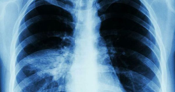 Dấu hiệu nhận biết viêm phổi