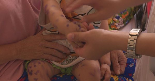 Bệnh tay chân miệng bùng phát tại Đắk Lắk