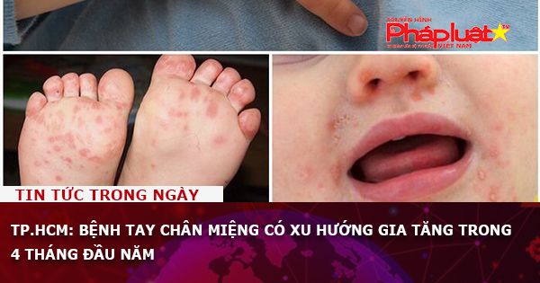 TP.HCM: Bệnh tay chân miệng có xu hướng gia tăng trong 4 tháng đầu năm